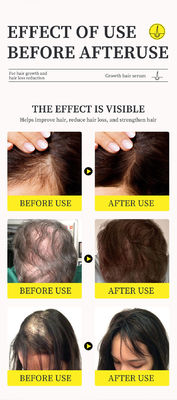 Potent Anti Hair Loss Treatment Serum with Ginger Oil and Vitamin B5